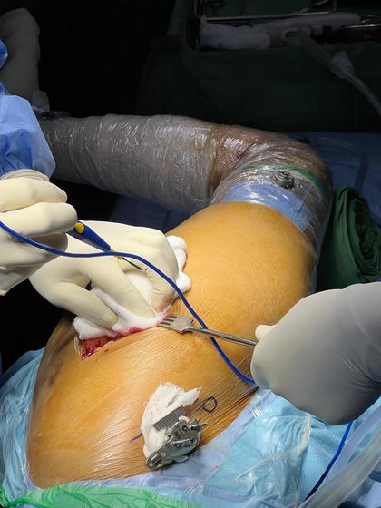 Optical tracker arrays fixed to bone during robotic knee surgery