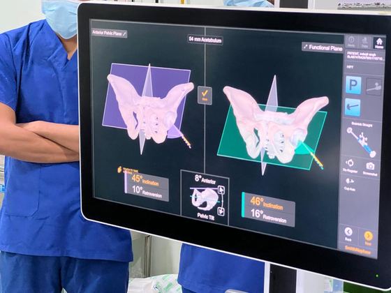 Robotic navigation screen showing 3-D hip planning with cup angles