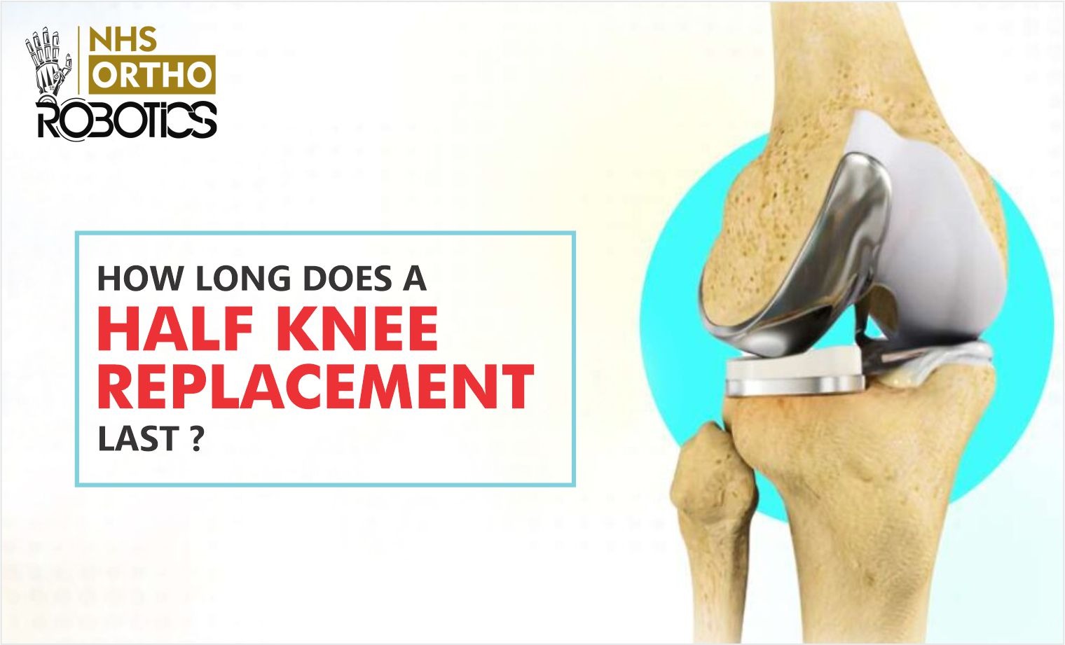 NHS creative: How long does a half knee replacement last, with a partial knee implant render