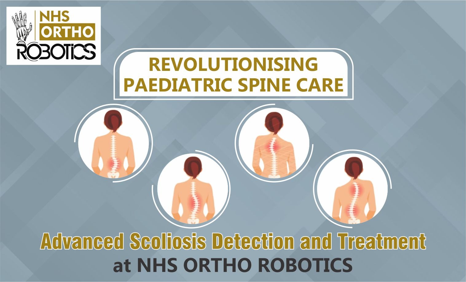 NHS creative: Revolutionising paediatric spine care, advanced scoliosis detection and treatment